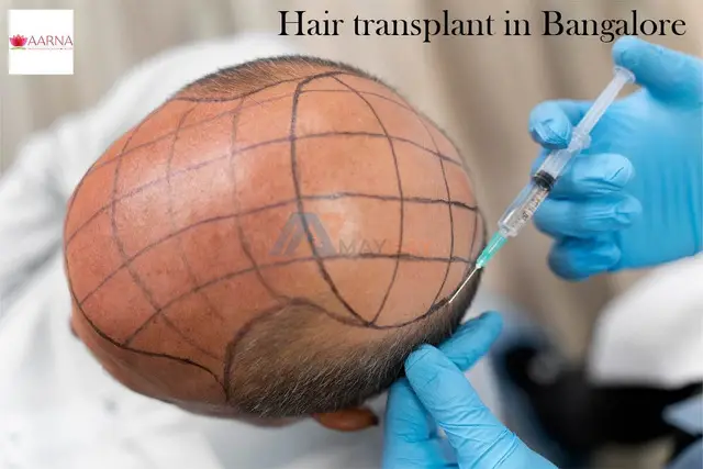 Hair Transplant in Bangalore - 1