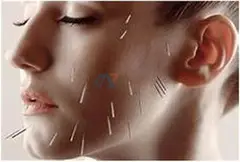 How cosmetic acupuncture can help you get glowing skin?