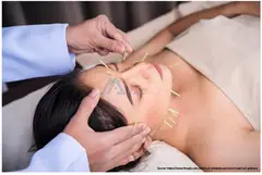 Top 5 Facts to Know About Facial Acupuncture - 1