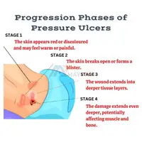 Progression phases of pressure ulcers | Synerheal Pharmaceuticals - 1