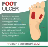 Healing Foot Ulcers with Advanced Wound Care Solutions
