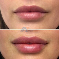 Best lip filler in Delhi