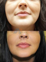 Facial Filler Treatments in Delhi